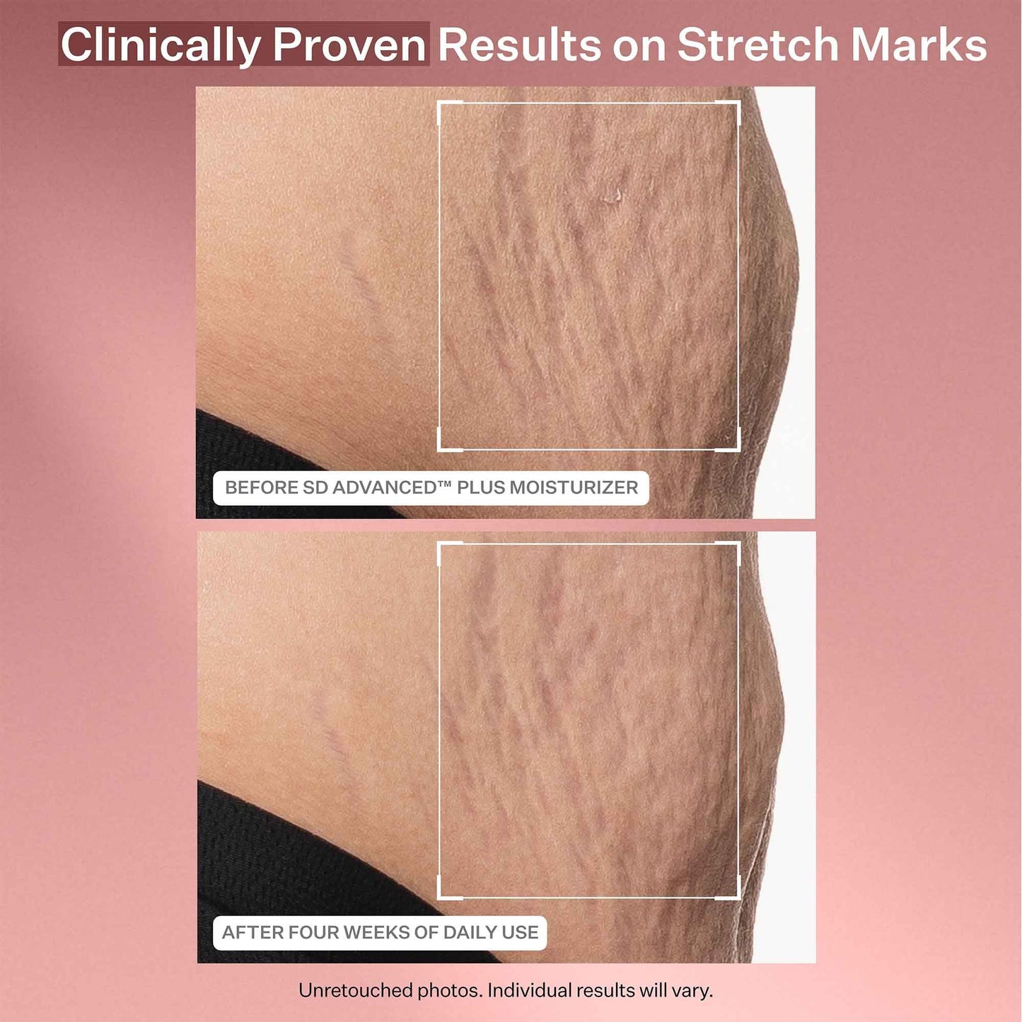 StriVectin SD Advanced Plus Intensive Moisturizer for Wrinkles and Stretchmarks, For Face and Body, Collagen Boosting with Peptides and Hyaluronic Acid