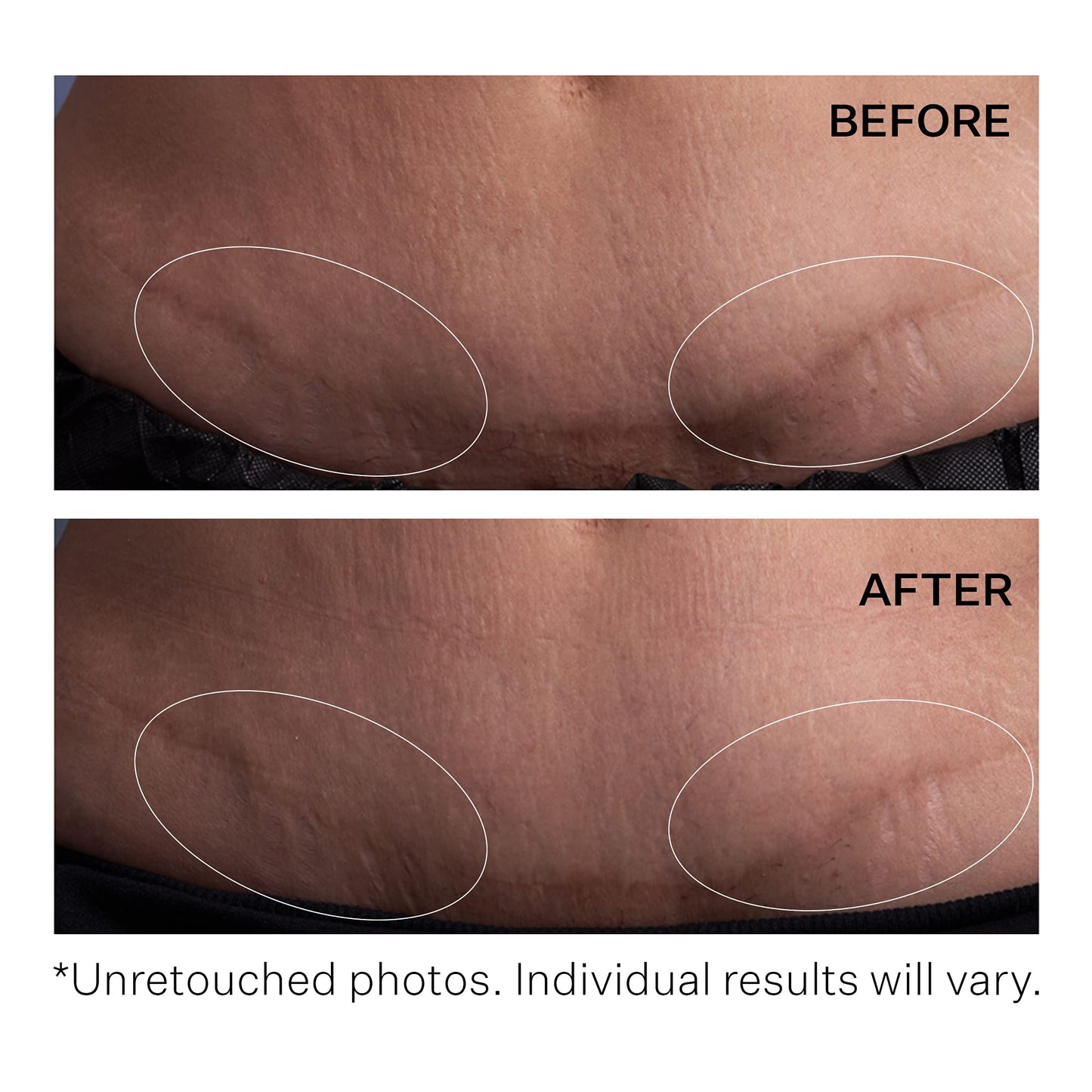 StriVectin SD Advanced Plus Intensive Moisturizer for Wrinkles and Stretchmarks, For Face and Body, Collagen Boosting with Peptides and Hyaluronic Acid