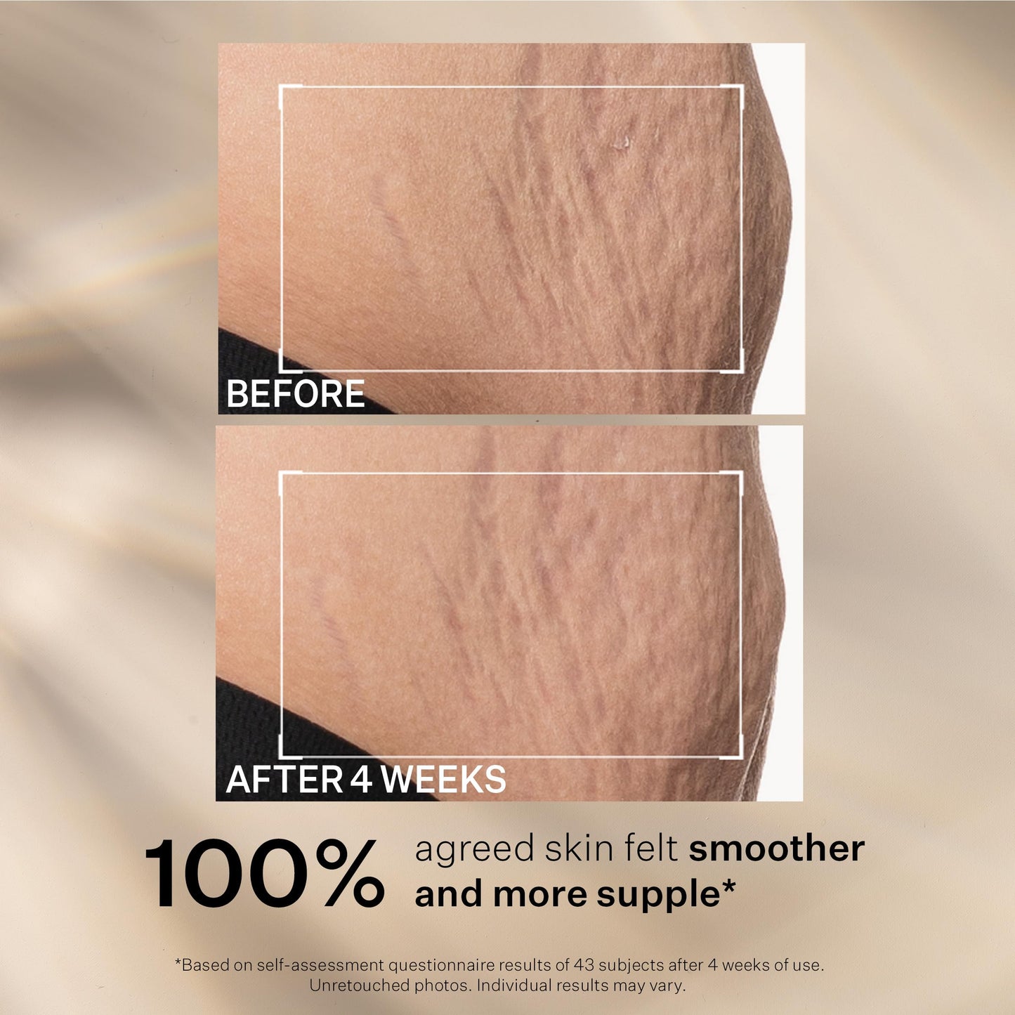 StriVectin SD Advanced Plus Intensive Moisturizer for Wrinkles and Stretchmarks, For Face and Body, Collagen Boosting with Peptides and Hyaluronic Acid